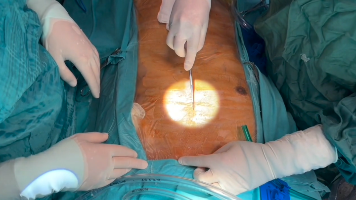Heart Transplantation 
