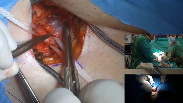 Minimally Invasive  AVR