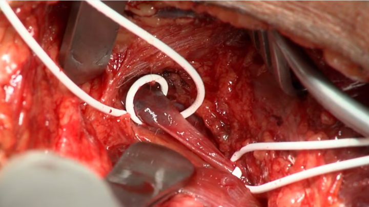 Vf-Vfp Trans Kort - WMV9