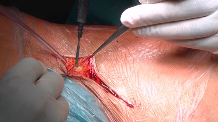 Endophlebectomy