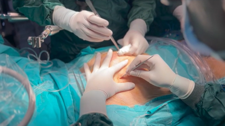 Minimally Invasive LV Mass Excision