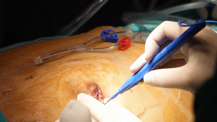 Totally Endoscopic Mitral Repair