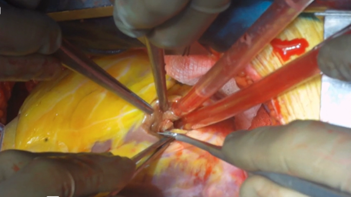 Concomitant Ventricular Septal Rupture Repair Suat 