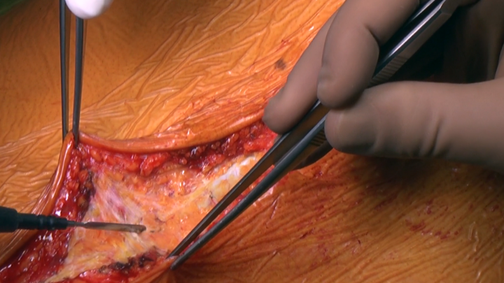 Celiac Trunk Aneurysm Repair