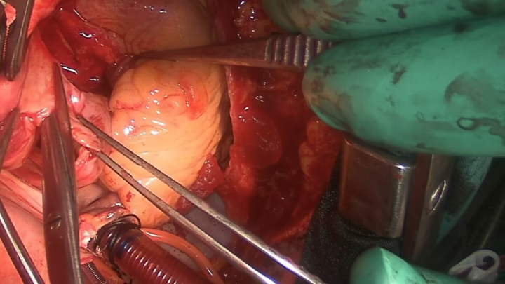 Valve Sparing Ascending Aorta Repair 