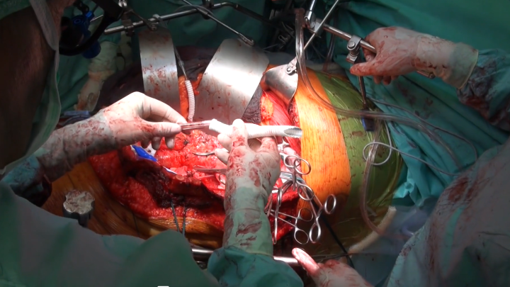 Surgical TAAA Repair