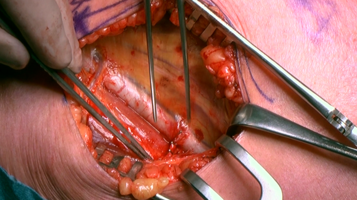 Femoral Vein Transposition