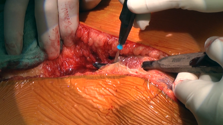 Surgical Repair Of The Type IV TAAA