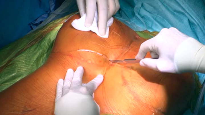 Redo Ascending And Arcus Aorta Surgery