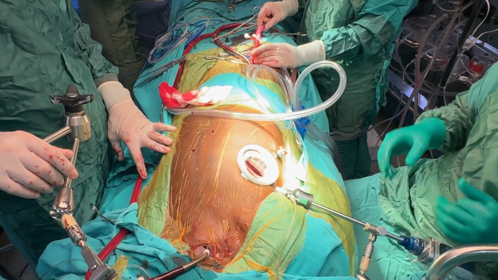 Minimally Invasive MVR 