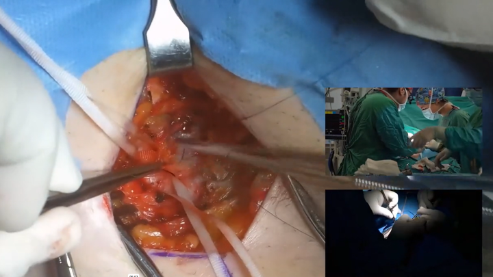 Port Access 3D Endoscopic Mitral Valve Repair