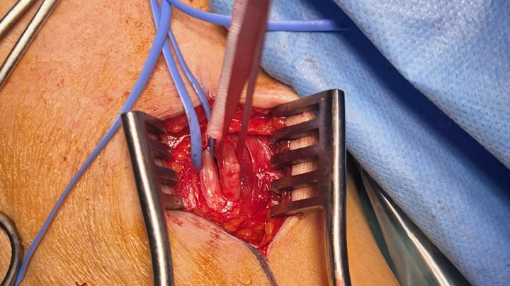 Total Endovascular Arch Replacement